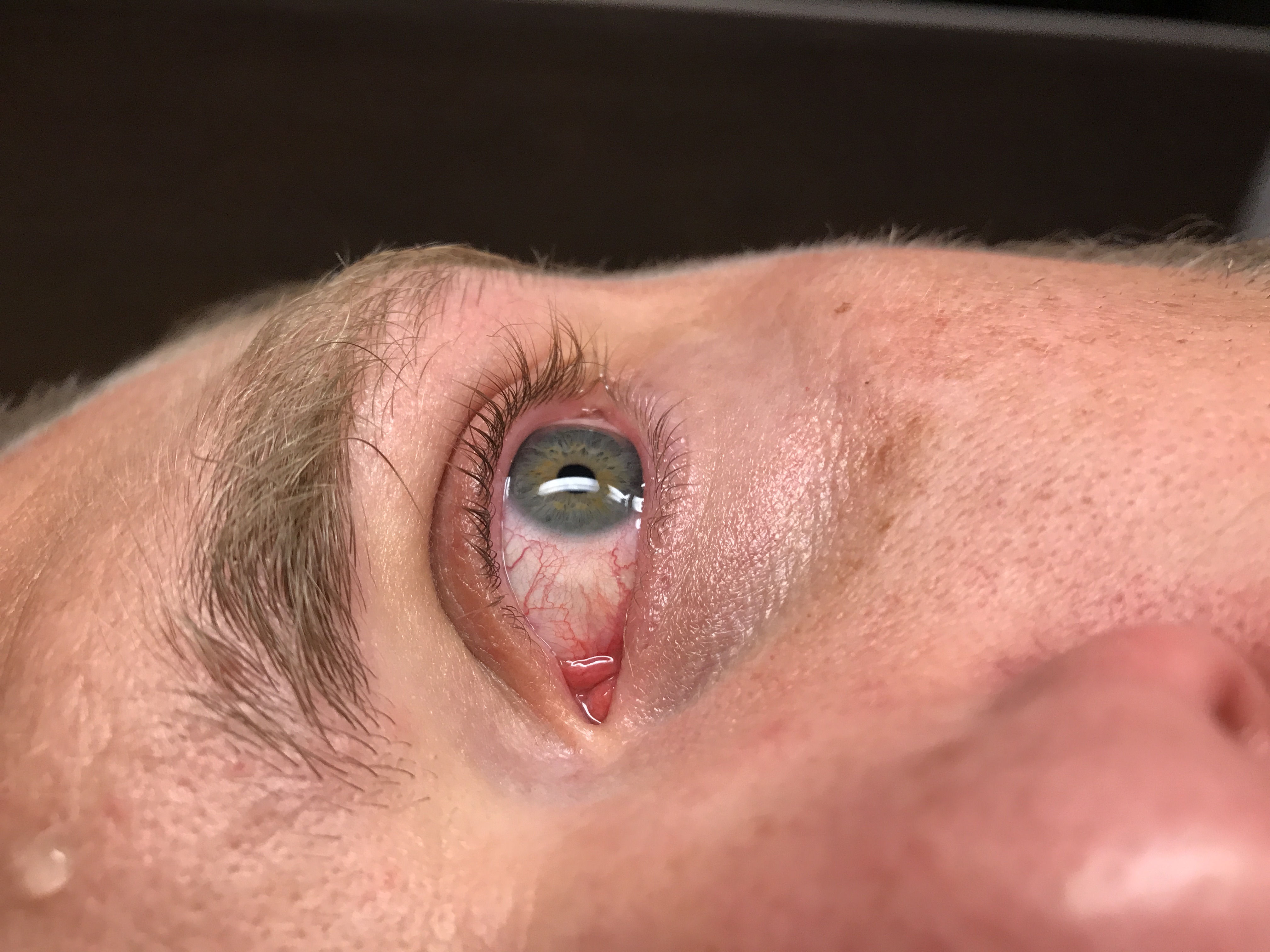 Ackermann's irritated eye before using the solution.