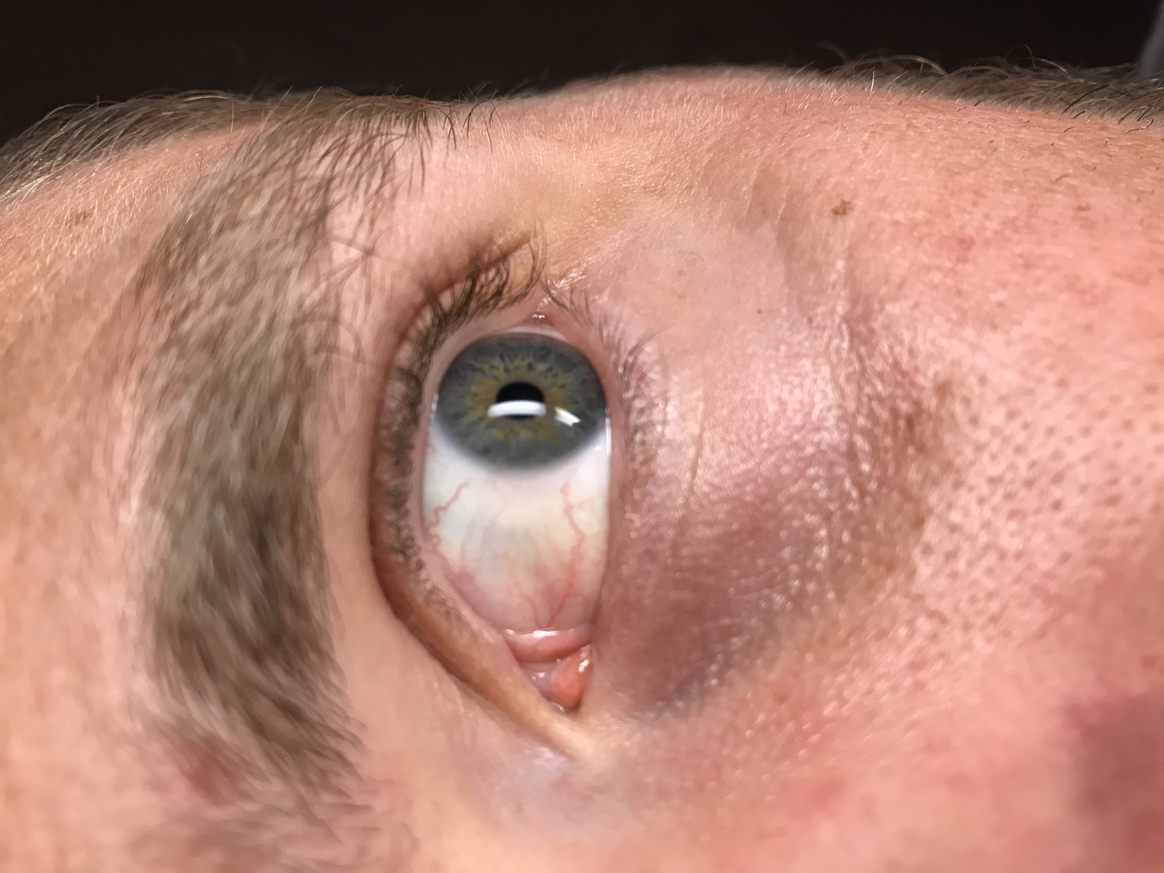 Ackermann's eye after using the solution.